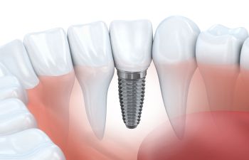 Little Rock AR Tooth Replacement Dentist